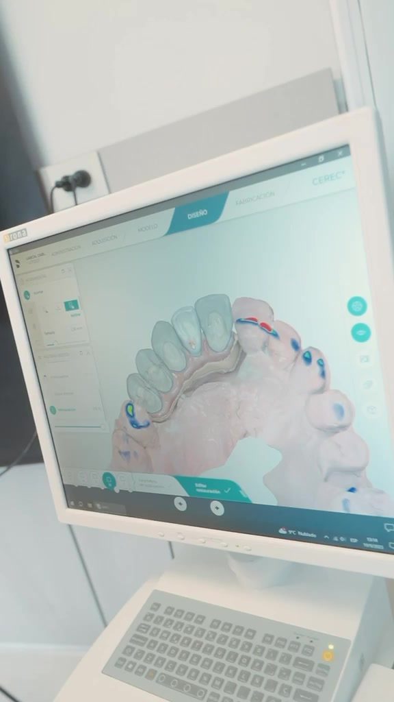 Diseño digital de una restauración dental en pantalla