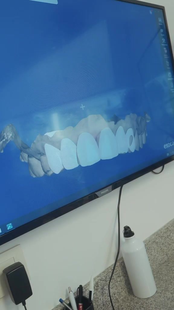 Sonrisa diseñada en 3D en la pantalla de la clínica